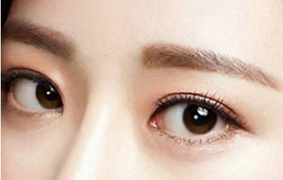 做埋線雙眼皮后時(shí)間長了會(huì)斷線嗎