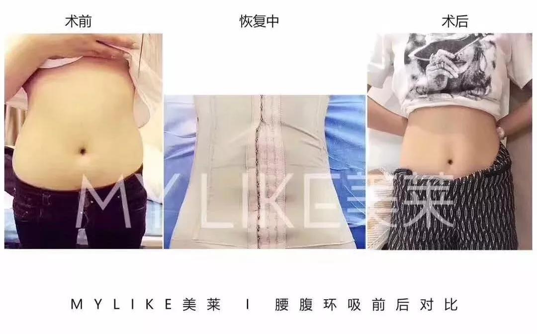 吸脂減肥是優(yōu)勢(shì)有哪些