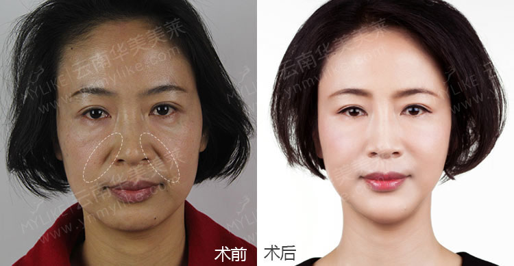 注射玻尿酸除皺手術(shù)后，需要注意哪些事項(xiàng)？