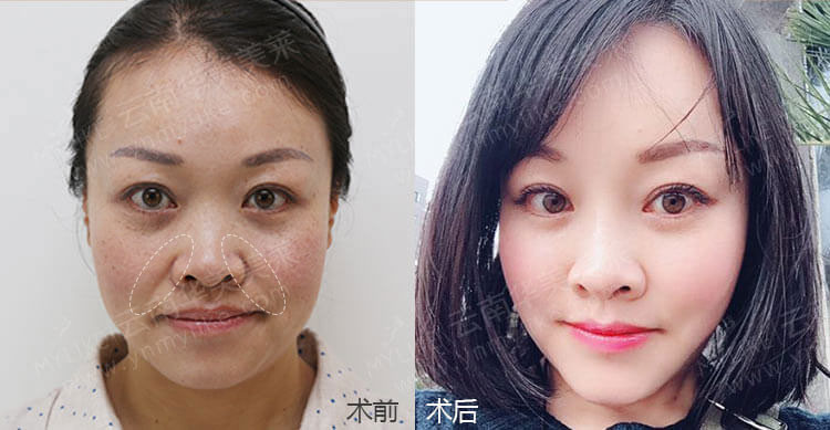 注射玻尿酸除皺手術(shù)后，需要注意哪些事項(xiàng)？