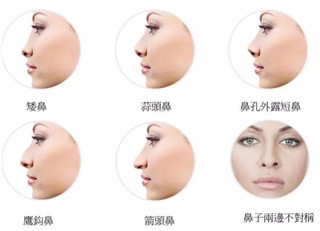 昆明美萊假體隆鼻費(fèi)用多少