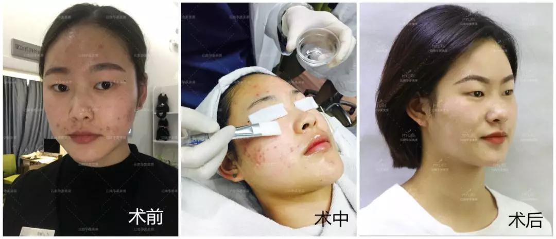 經(jīng)常長痘，美萊果酸祛痘效果怎么樣