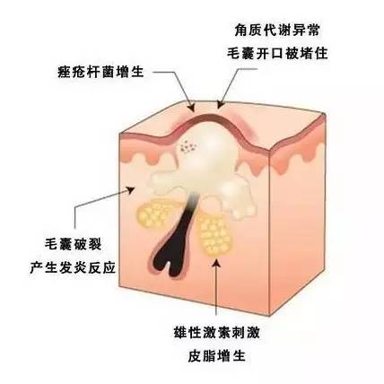 閉口和粉刺有什么區(qū)別，怎么祛除