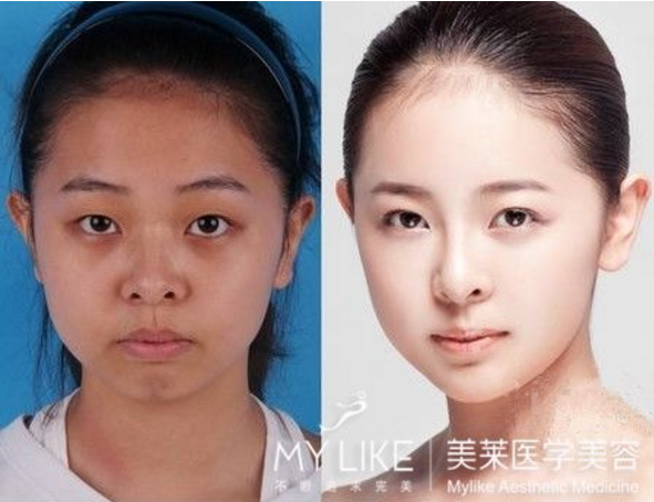 光子嫩膚對(duì)比