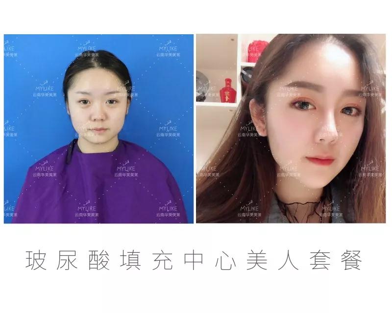 昆明打玻尿酸哪家好，打玻尿酸副作用有哪些？