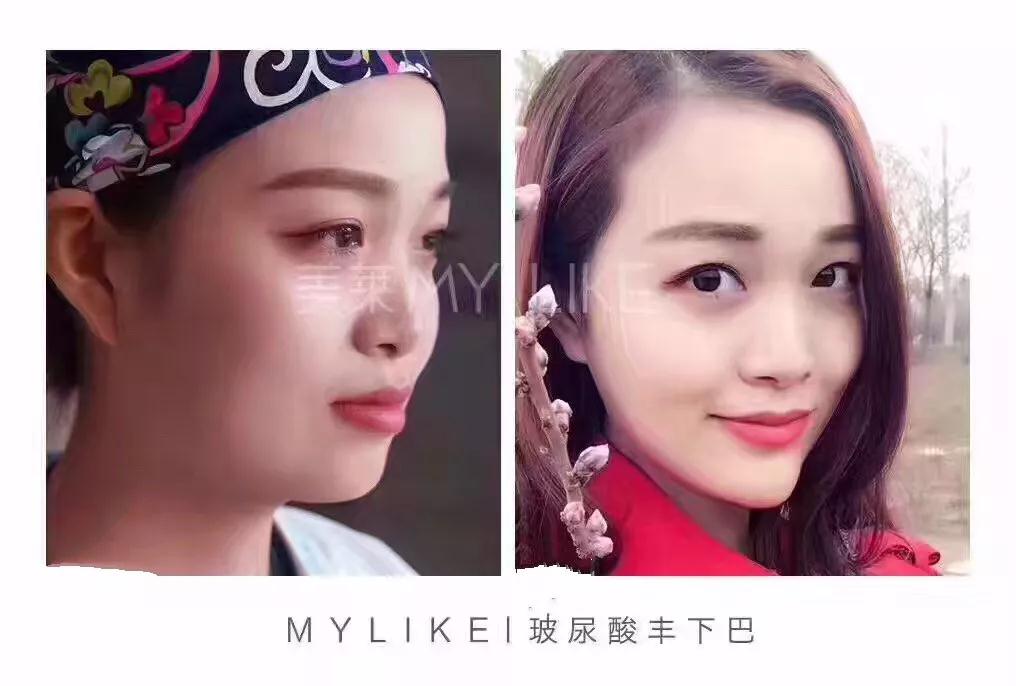 大中小分子玻尿酸有什么區(qū)別，法令紋又是用的什么