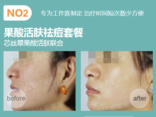 華美美萊果酸祛痘，拍照告別P圖！