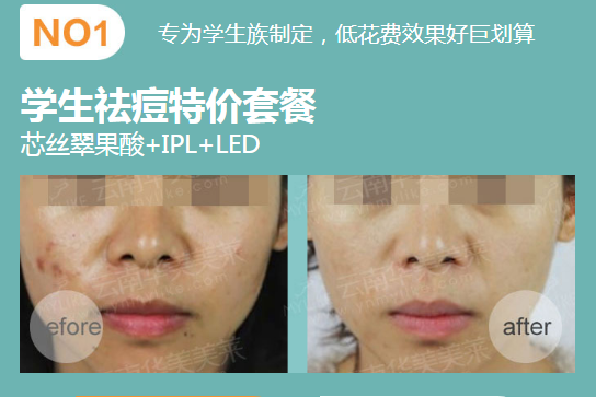 華美美萊果酸祛痘，拍照告別P圖！