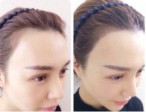 發(fā)際線種植一般需要多少錢(qián)？