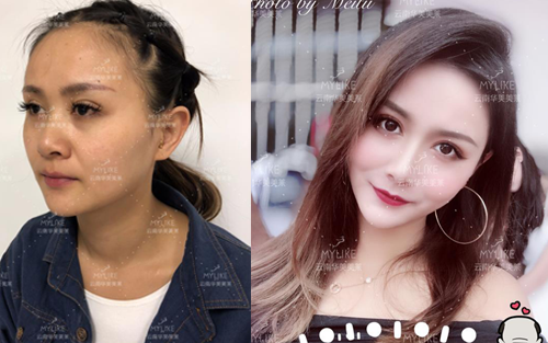 2013年世界旅游小姐西南賽區(qū)季軍必做的醫(yī)美項目！美萊雙十一火爆來襲！