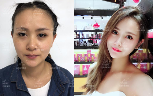 2013年世界旅游小姐西南賽區(qū)季軍必做的醫(yī)美項目！美萊雙十一火爆來襲！