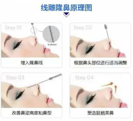 昆明大理做*雕隆鼻整形多少錢