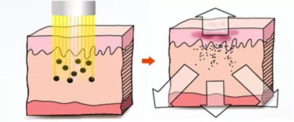 長斑和大姨媽有沒有關(guān)聯(lián)？