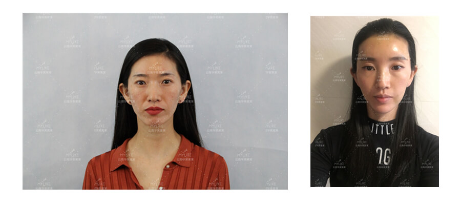 2011年環(huán)球游艇模特大賽十佳及單項獎小姐姐必做的醫(yī)美項目！！美萊雙十一get好物推薦