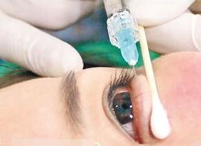 玻尿酸填充淚溝可以維持多長時(shí)間