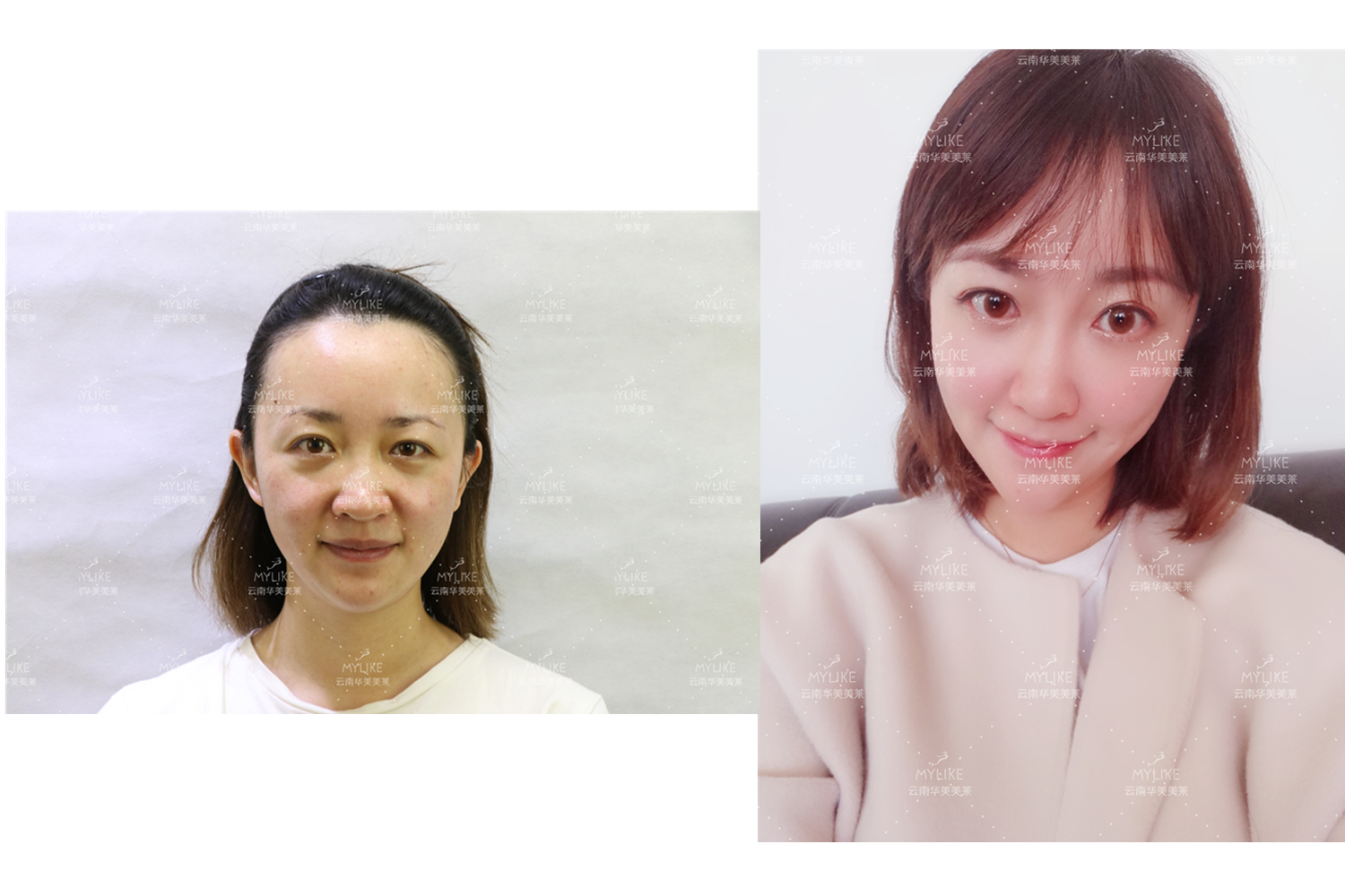 出演電視劇《官渡人家》的小姐姐必做的醫(yī)美項(xiàng)目??！美萊雙十一get好物推薦