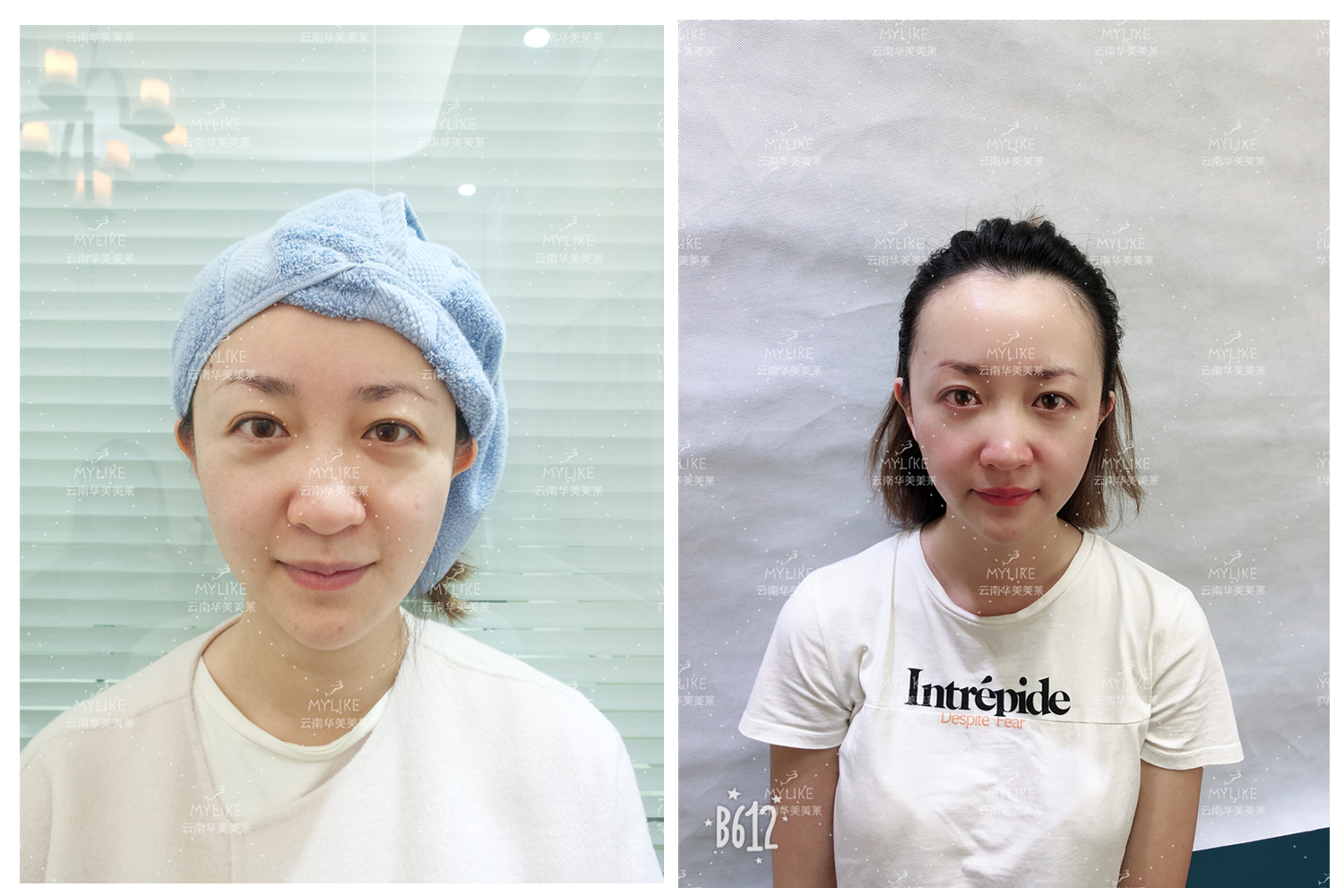 出演電視劇《官渡人家》的小姐姐必做的醫(yī)美項(xiàng)目??！美萊雙十一get好物推薦