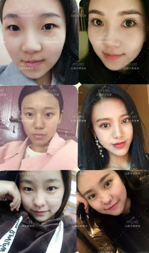 昆明影響割雙眼皮的因素有哪些，多少錢