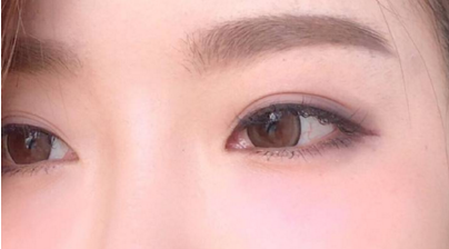 開(kāi)眼角手術(shù)要幾天才能拆線(xiàn)