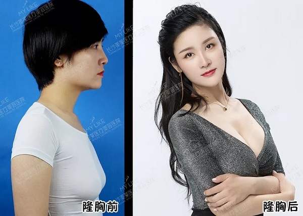 <a href='/cs/' target='_blank'><u>長(zhǎng)沙美萊</u></a>年終隆胸盛惠，該選圓盤(pán)or水滴？