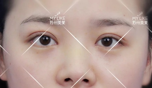 <a href='/suz/' target='_blank'><u>蘇州美萊</u></a>醫(yī)師叫您怎樣側(cè)面正面看鼻子的弧度