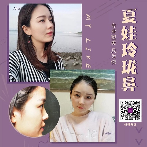 <a href='/sh' target='_blank'><u>上海美萊</u></a>做完假體隆鼻能激吻嗎？鼻子會(huì)不會(huì)太假呢