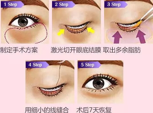 <a href='/sy/' target='_blank'><u>沈陽美萊</u></a>講解眼袋到底有多嚇人，你敢看嗎？