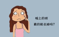 廣州激光祛斑后會留下疤痕嗎