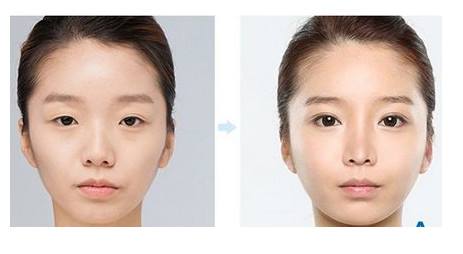 深圳上眼瞼下垂怎么治療？