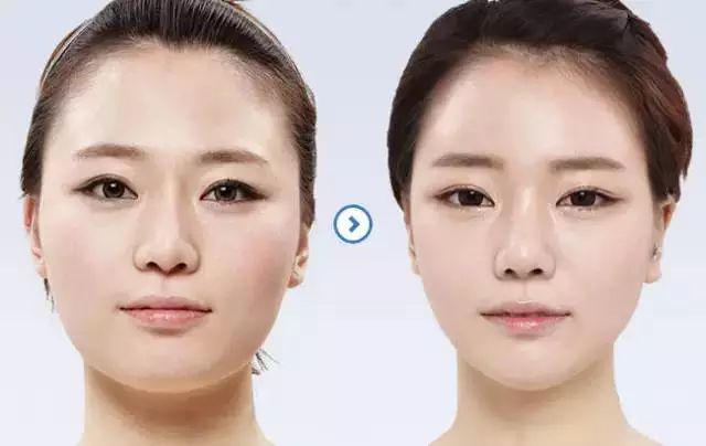 新年變美攻略：<a href='/sz/' target='_blank'><u>深圳美萊</u></a>瘦臉，讓你秒殺各種聚會圈！