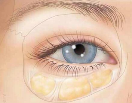 祛眼袋要花多少錢