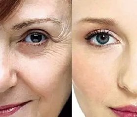 面部除皺的費用貴不貴？