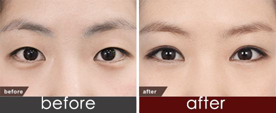 雙眼皮手術多少價格
