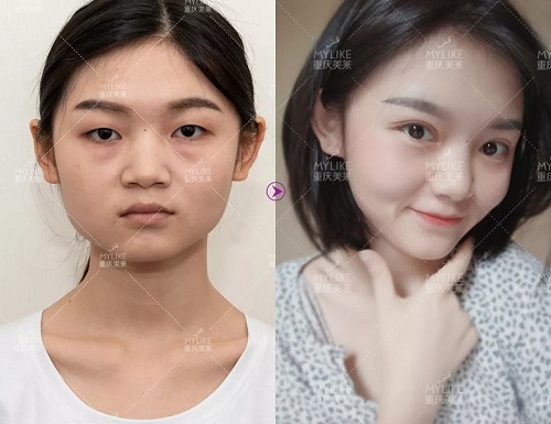 <a href='/cq/' target='_blank'><u>重慶美萊</u></a>逆襲小單眼鹿眼，蛻變竟只需7天！