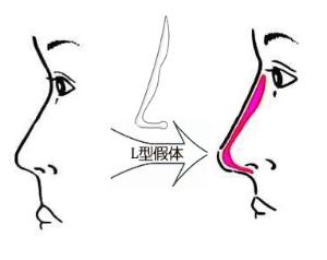 深圳假體隆鼻失敗修復(fù)多少錢(qián)？