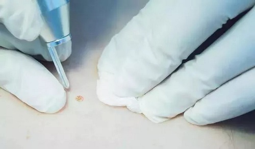 <a href='/qz/' target='_blank'><u>泉州美萊</u></a>醫(yī)師，我想點(diǎn)痣...  ?