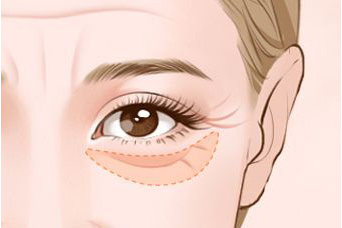 超聲法去眼袋多少錢(qián)