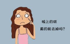 深圳激光祛斑后還會(huì)反彈？