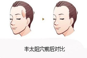 成都面部填充用什么材料比較好？