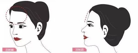 成都做自體脂肪面部填充可以維持十年嗎？