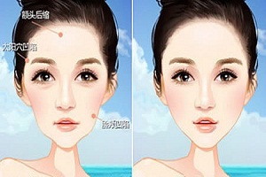 自體脂肪面部填充