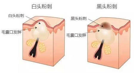 BYE-BYE草莓鼻,密集“孔”懼癥,來美萊吧！