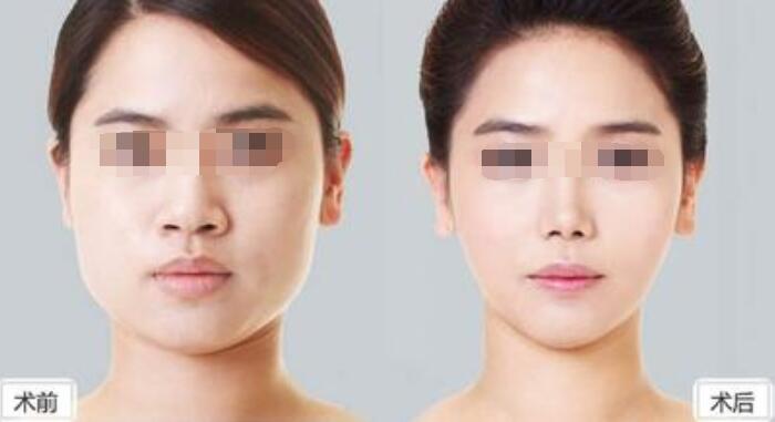 深圳吸脂減肥手術(shù)哪些部位可以做？