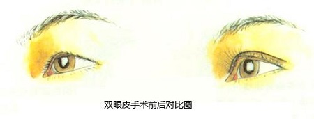 雙眼皮修復術(shù)后何時能消腫