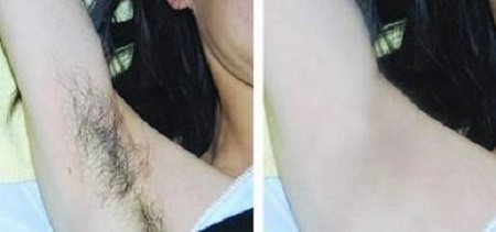 冰點(diǎn)脫腋毛后還會(huì)復(fù)發(fā)嗎