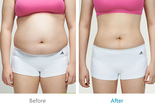 吸脂減肥手術(shù)要多少錢(qián)