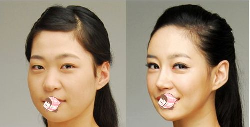 鼻頭縮小手術(shù)恢復(fù)時間要多長呢？