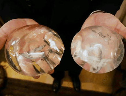 豐胸整形術(shù)后應(yīng)注意什么呢？