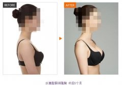 假體隆胸價(jià)格是多少？