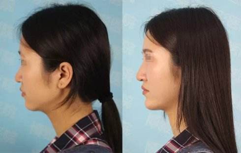 隆鼻后修復(fù)手術(shù)恢復(fù)時(shí)間會(huì)更長(zhǎng)嗎？